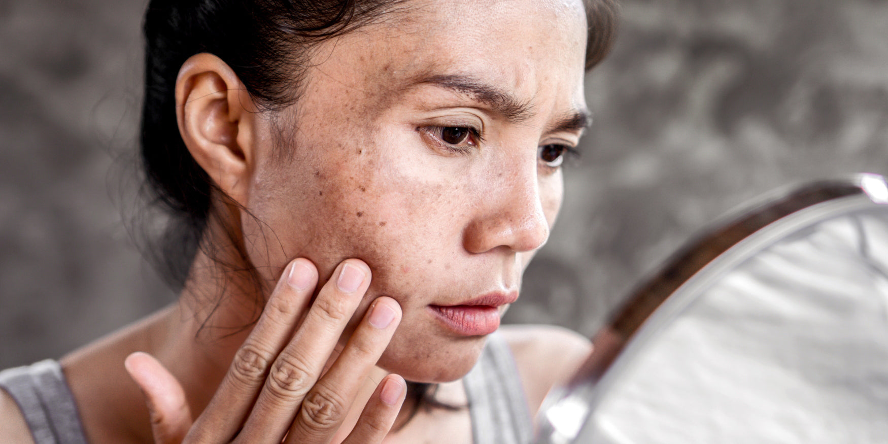 What causes hyperpigmentation?