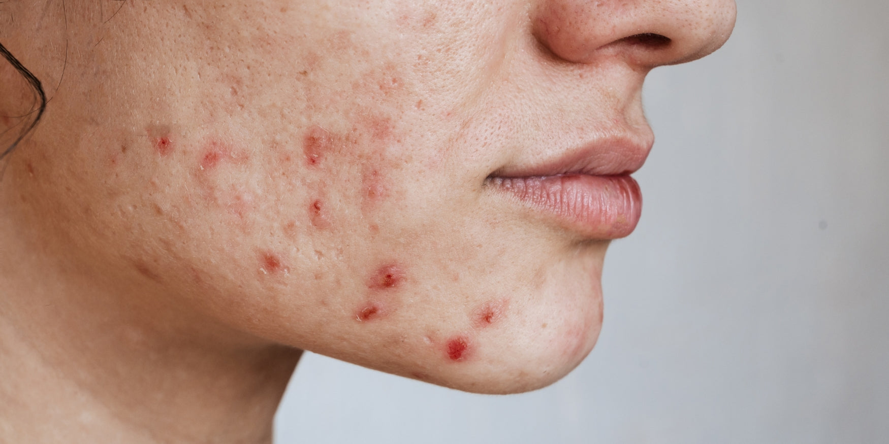 Five Steps for Treating Problem-Prone Skin with Environ Skin Care