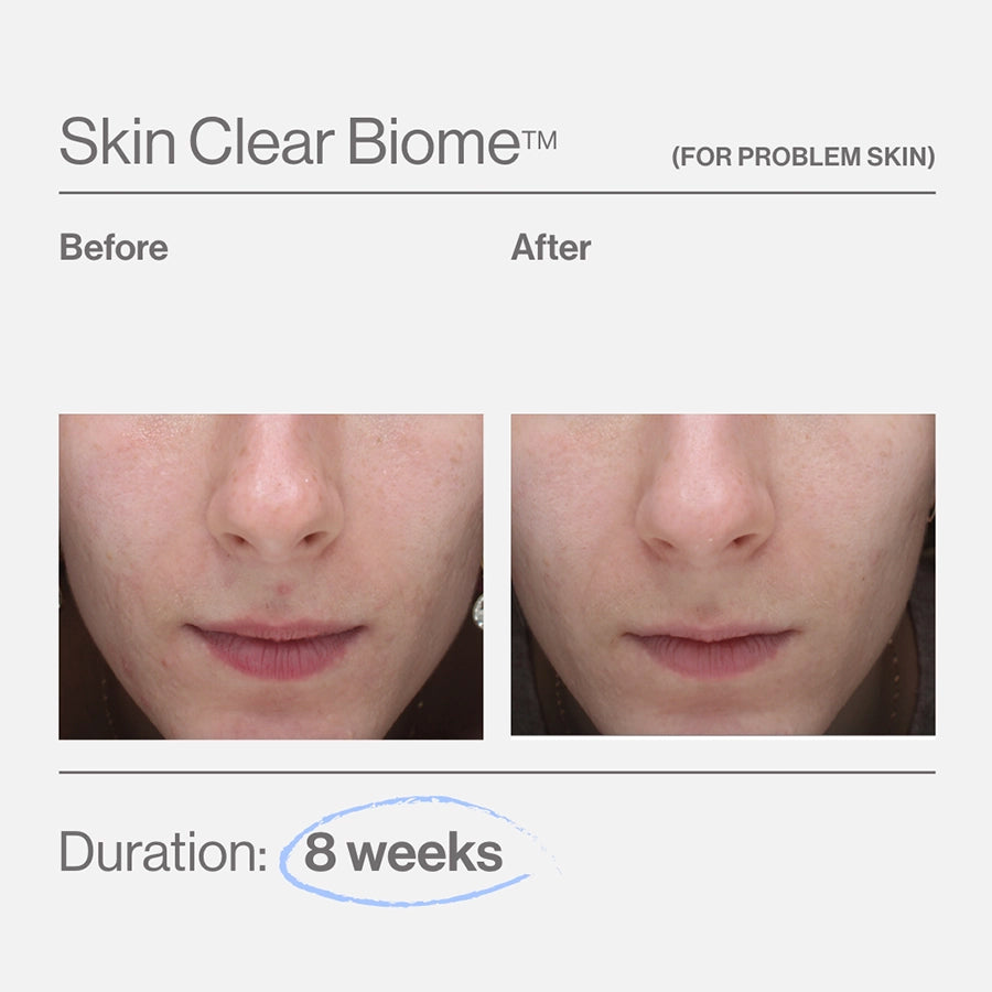 Advanced Nutrition Programme Skin Clear Biome brand-supplied before and after image